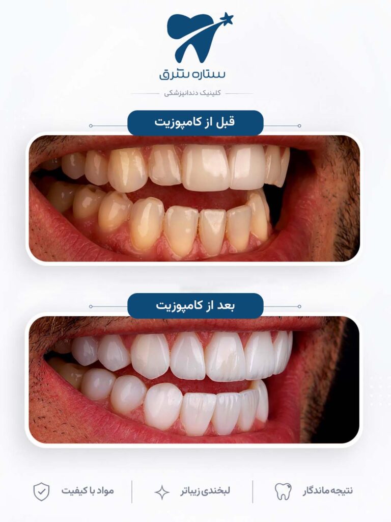 کامپوزیت دندان