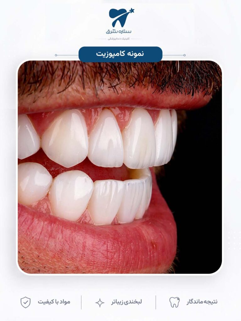 کامپوزیت دندان