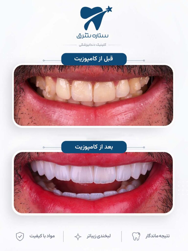 کامپوزیت دندان