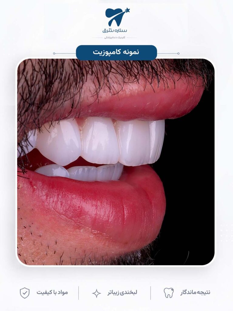 کامپوزیت دندان