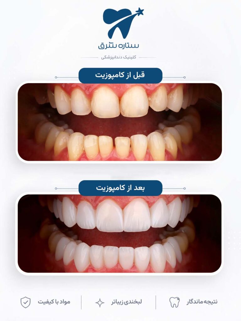 کامپوزیت دندان