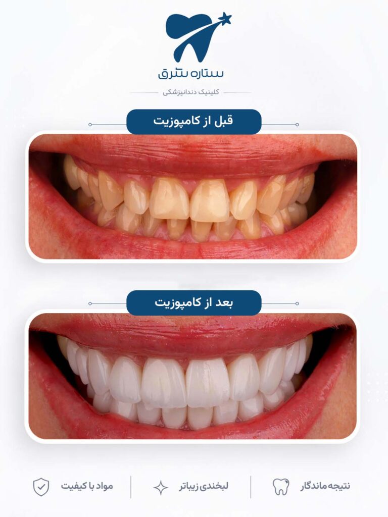 کامپوزیت دندان