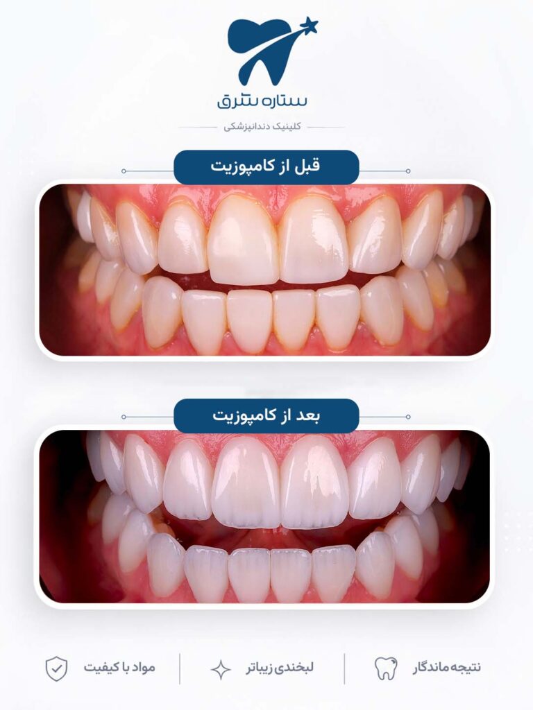 کامپوزیت دندان