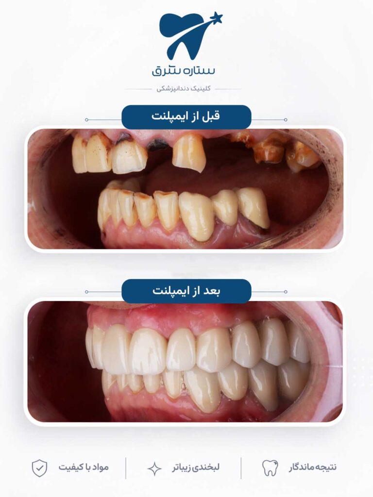 ایمپلنت دندان