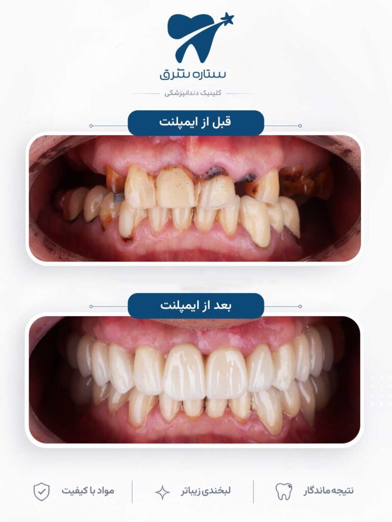 ایمپلنت دندان