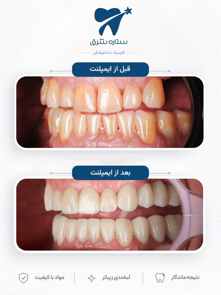 ایمپلنت دندان