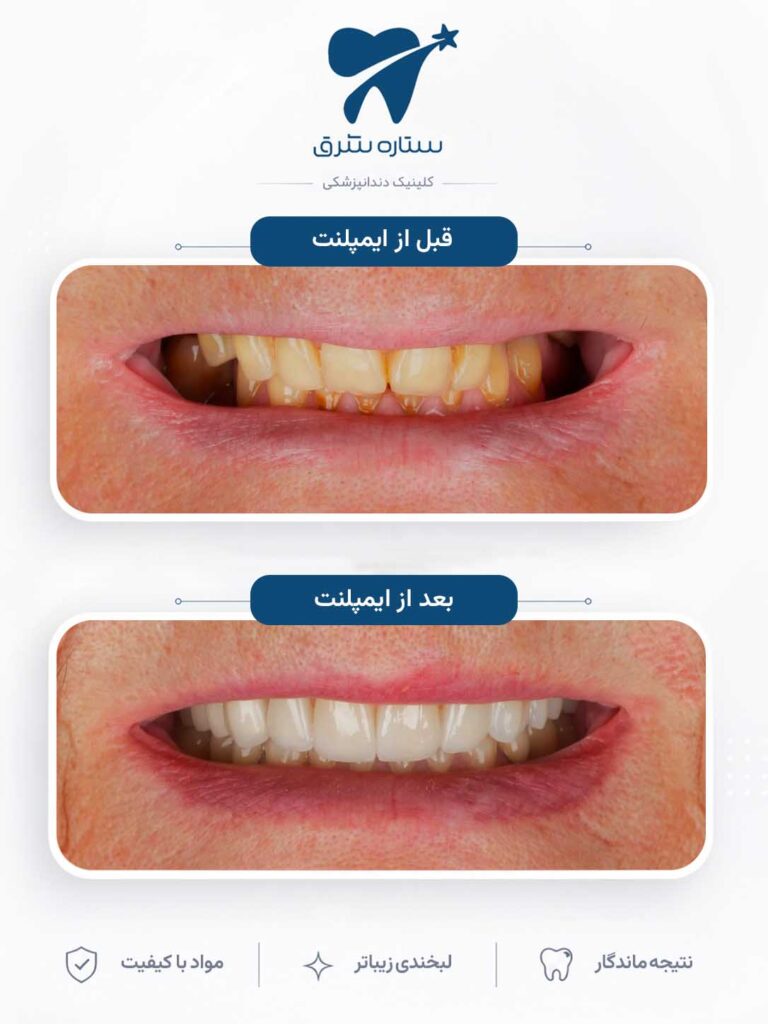 ایمپلنت دندان