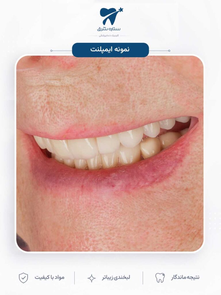 ایمپلنت دندان