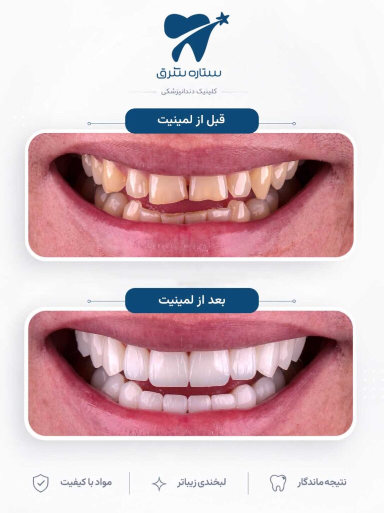 لمینیت دندان