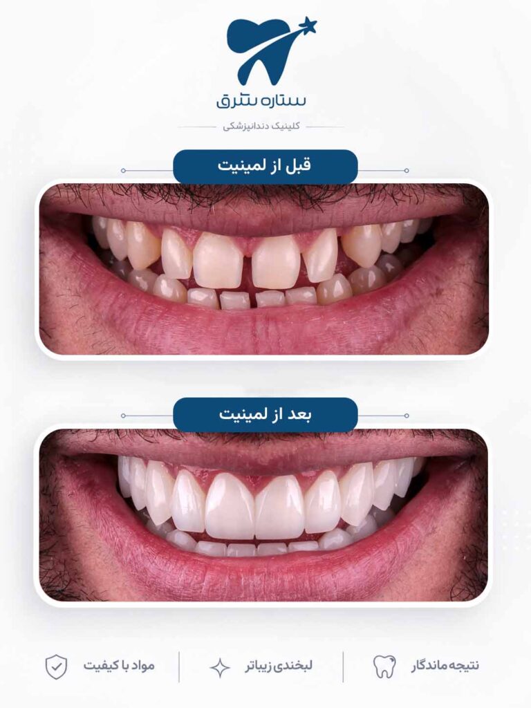 لمینیت دندان