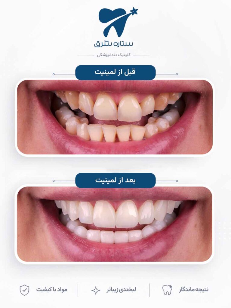 لمینیت دندان