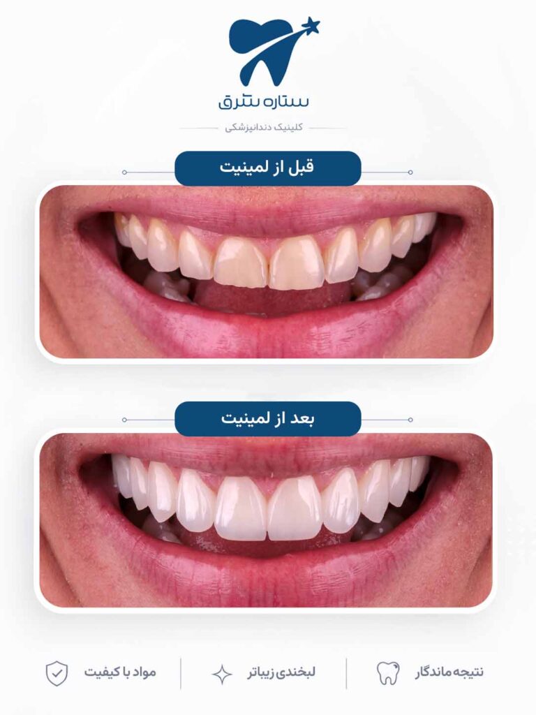 لمینیت دندان