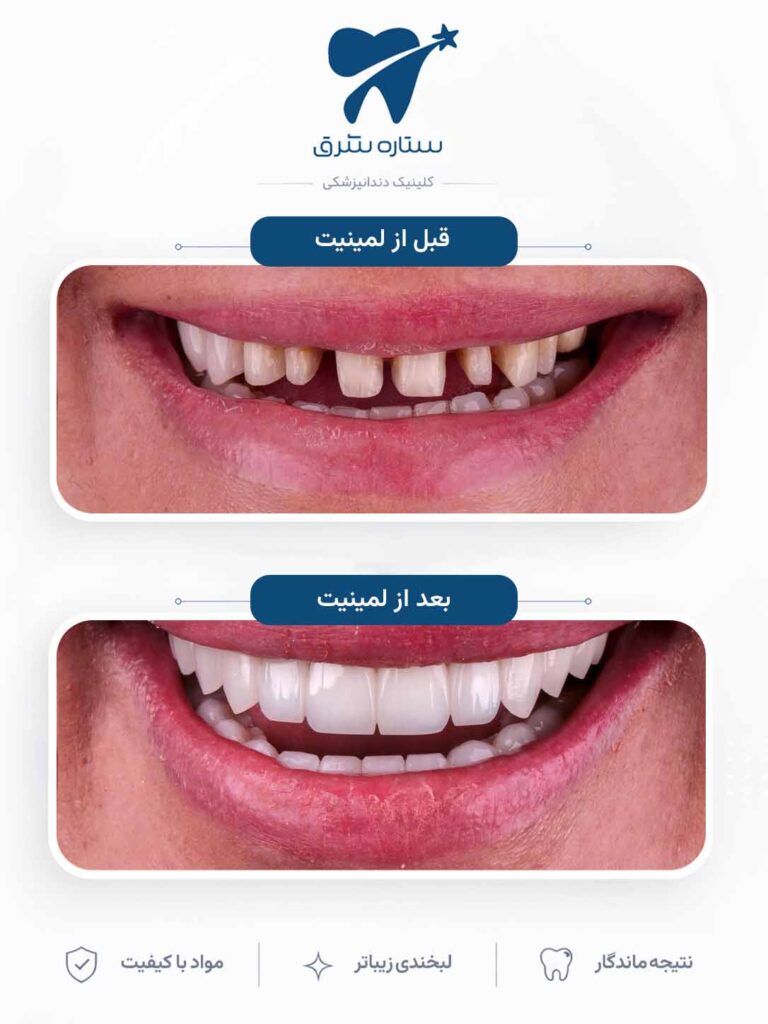 لمینیت دندان