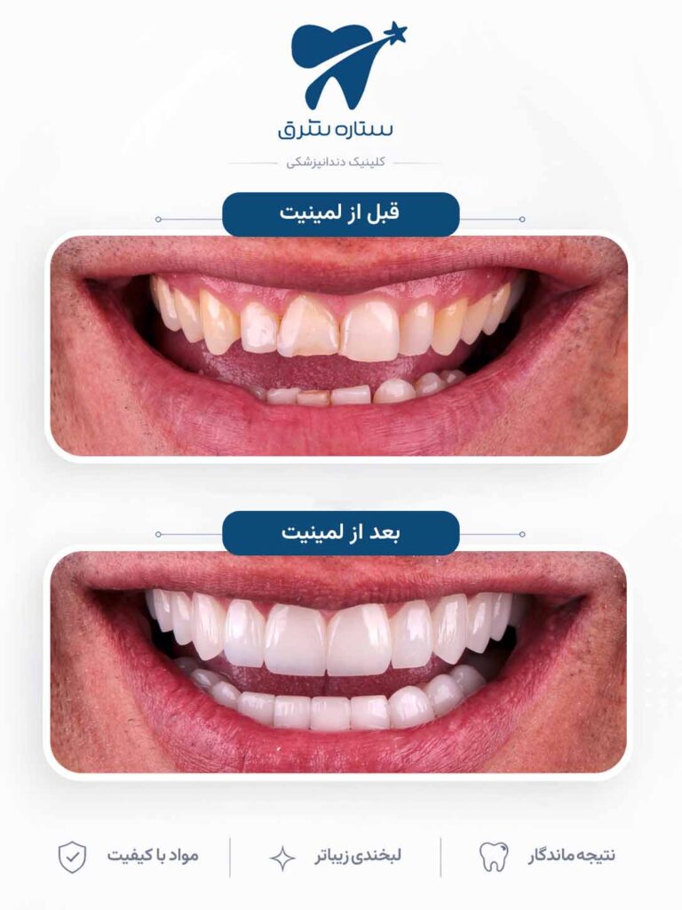 لمینیت دندان