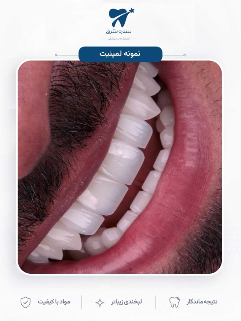 لمینیت دندان