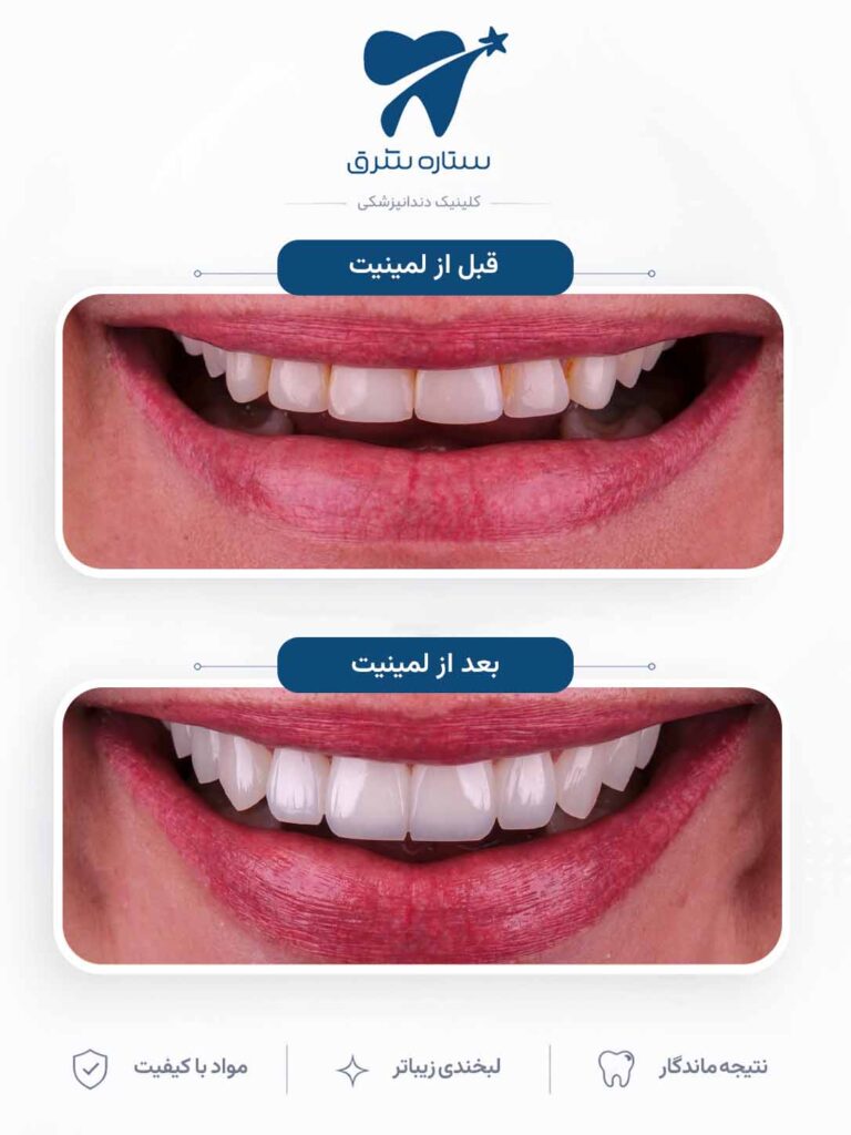 لمینیت دندان