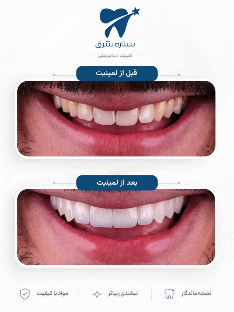 لمینیت دندان