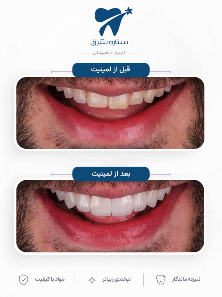 لمینیت دندان