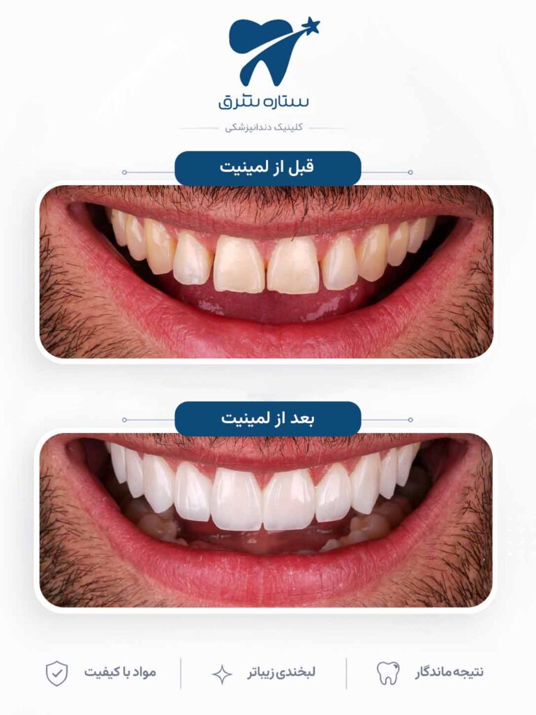 لمینیت دندان