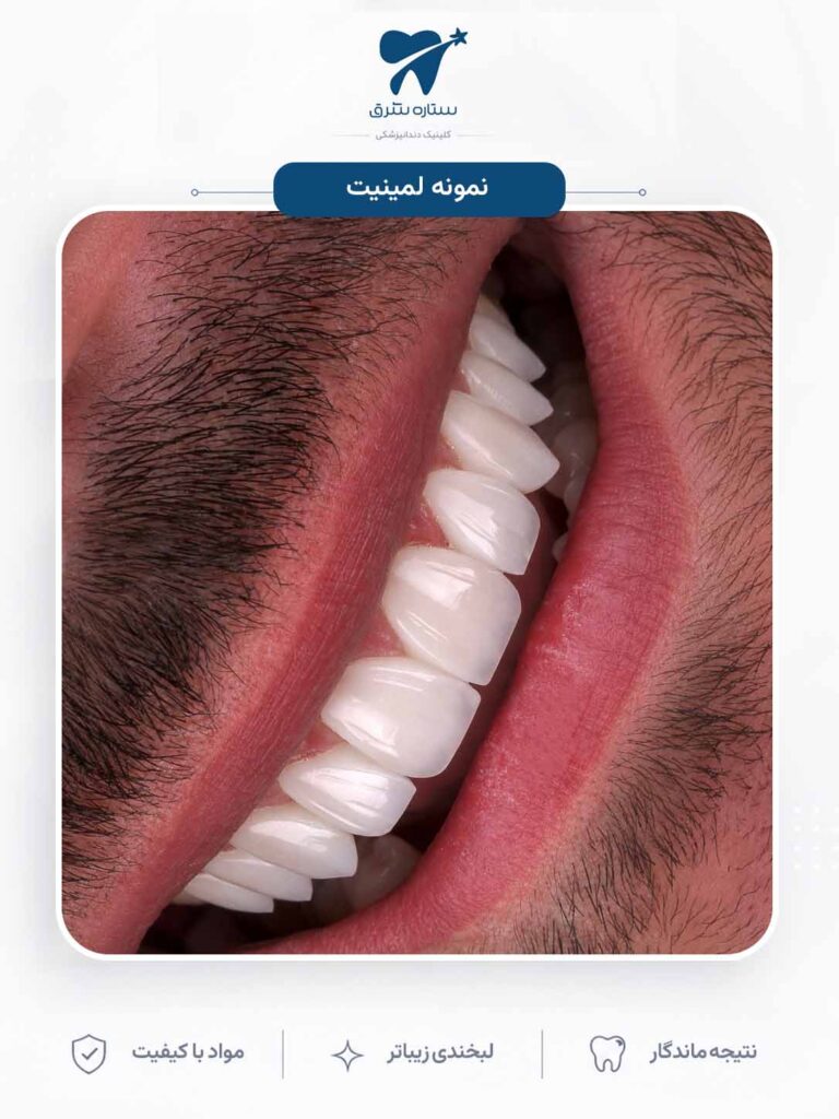 لمینیت دندان