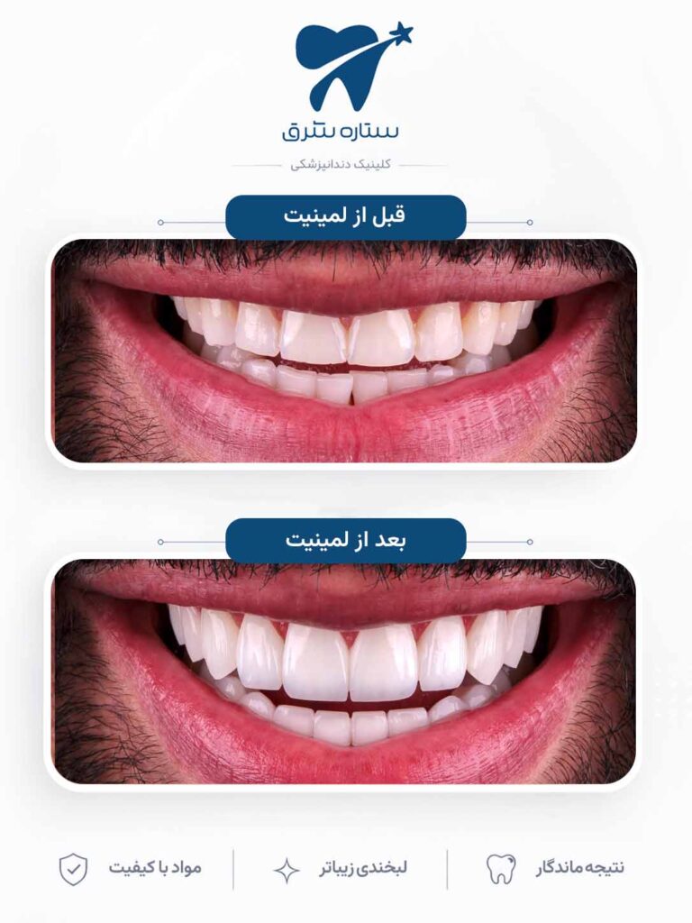 لمینیت دندان
