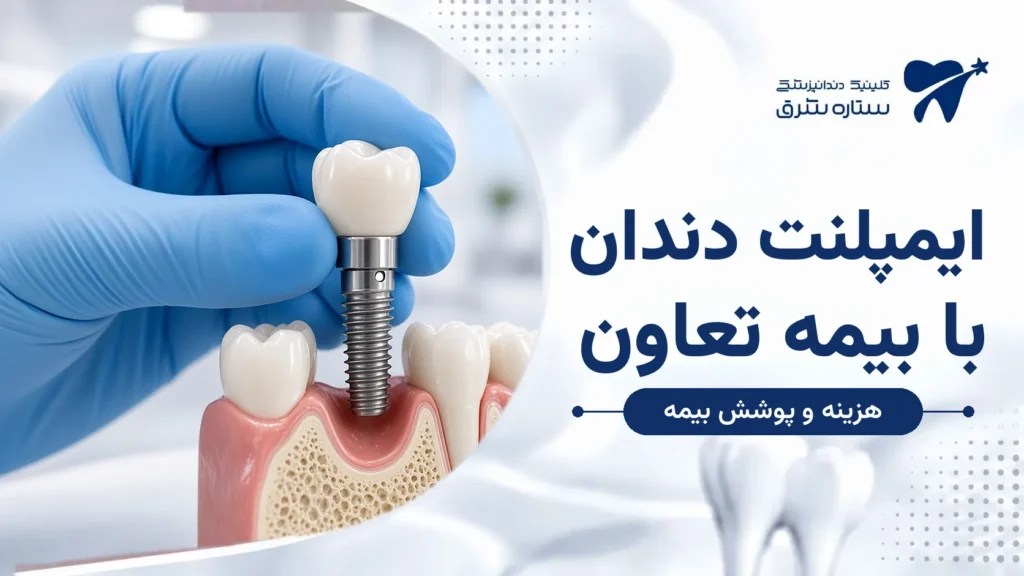 ایمپلنت با بیمه تعاون؛ شرایط پوشش، هزینه و راهنمای انتخاب مرکز
