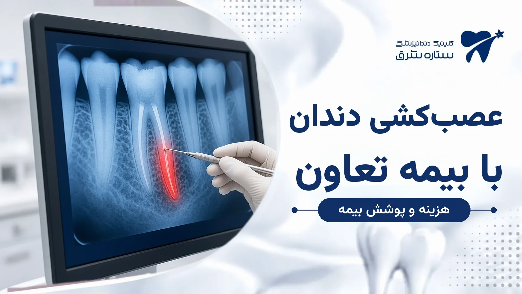 عصب‌کشی با بیمه تعاون؛ هزینه، شرایط پوشش و مدارک لازم